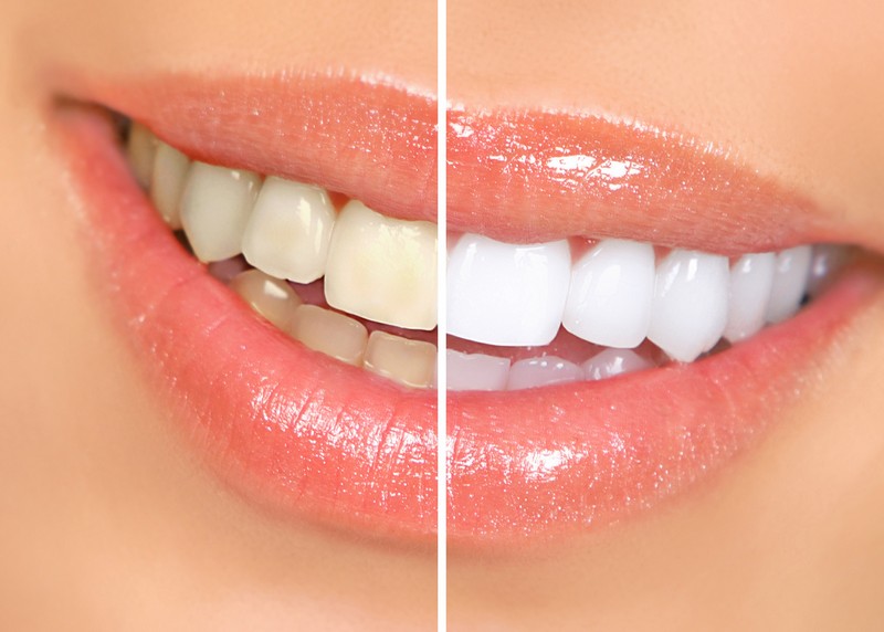 Teeth Whitening  Fairfax, VA 